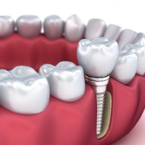What are Dental Implants, Why Are They Made?
